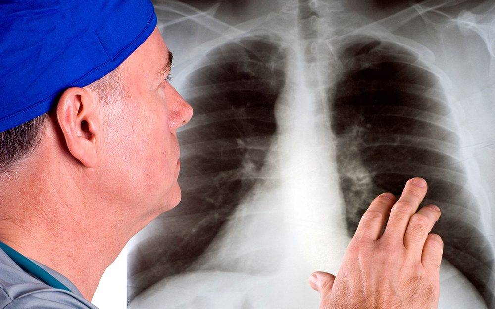 سرطان الرئة... علامات تحذيرية يمكن ملاحظتها على الوجه