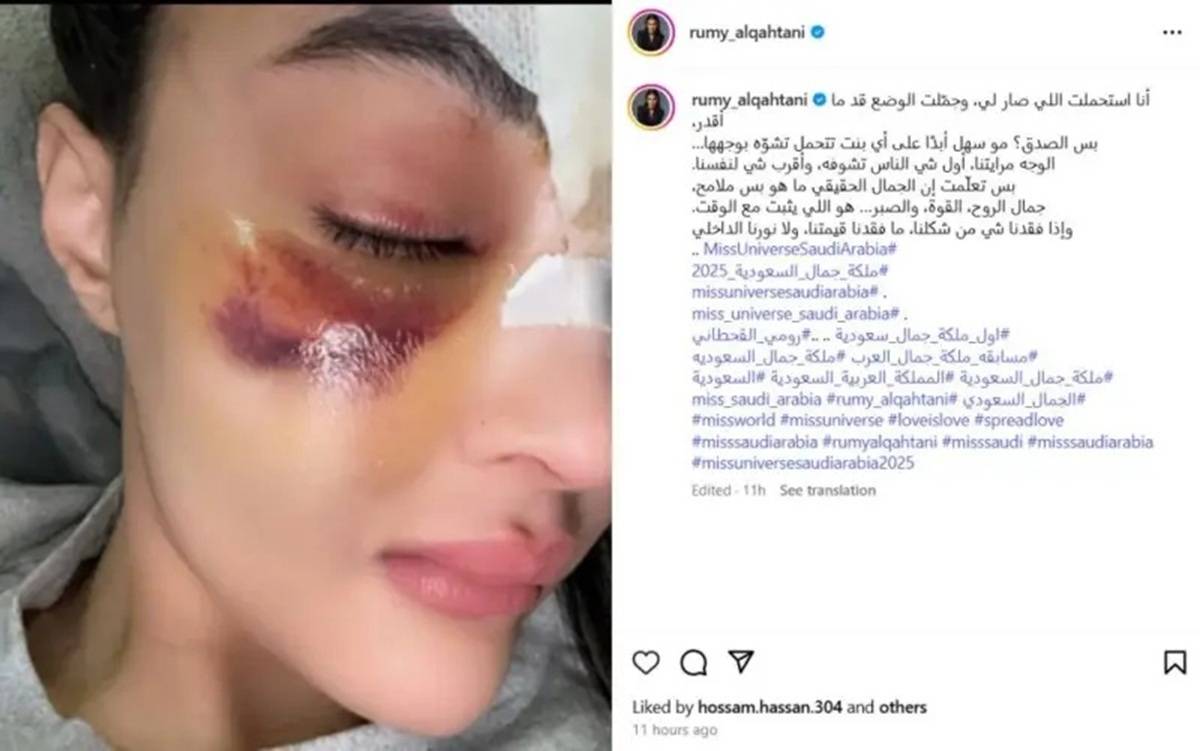 منشور رومي القحطاني عن الإصابة الثانية