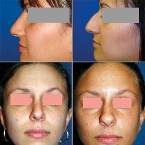 عمليات جراحية لتعديل الأنف