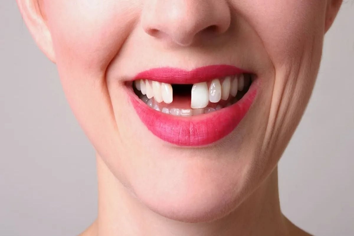 تفسير حلم سقوط الأسنان بدون دم ابن سيرين تفسير حلم سقوط الأسنان بدون دم ابن سيرين