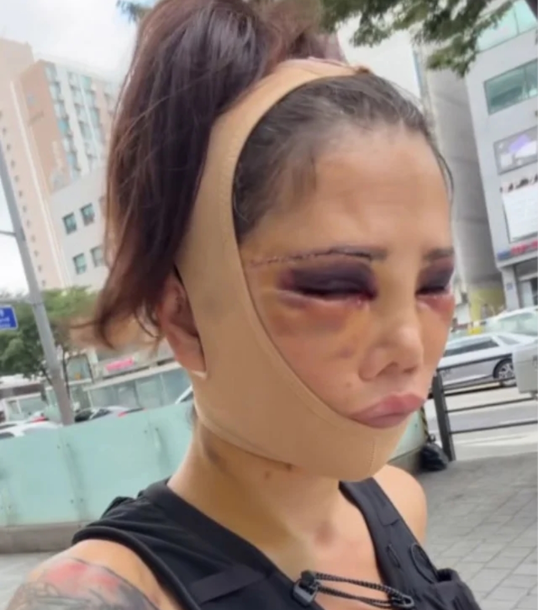 ديدم جيران تثير الجدل بعد عمليات تجميل في كوريا الجنوبية... رحلة مؤلمة وتعليقات قاسية تشعل مواقع التواصل الاجتماعي