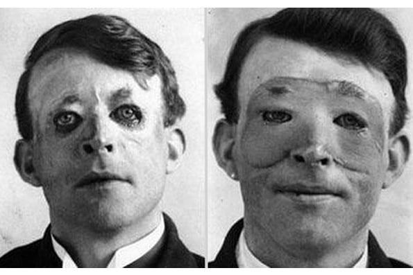 21-Walter Yeo one of the first to undergo an advanced plastic surgery and a skin transplant 1917