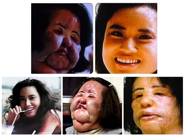 البوتوكس يحوّل اليابانية هانغ ميوكو إلى مسخ!