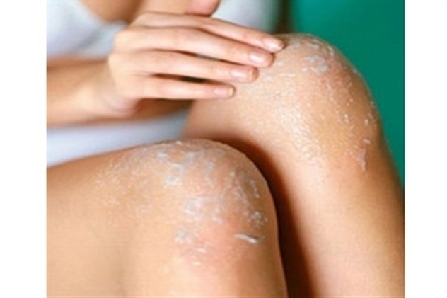 علاج لتفتيح وتوحيد لون الكوع والركب، وأيضاً الأماكن الحساسة