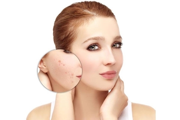 <strong  dir='ltr'>9</strong> نصائح سهلة للعناية بالبشرة الدهنية 