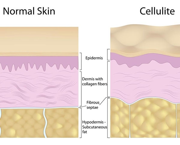 تخلصي الآن من السيلوليت!