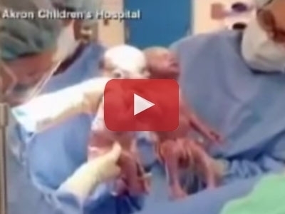 فيديو رائع- طفلة تولد من بطن أمها ممسكة يد أختها...