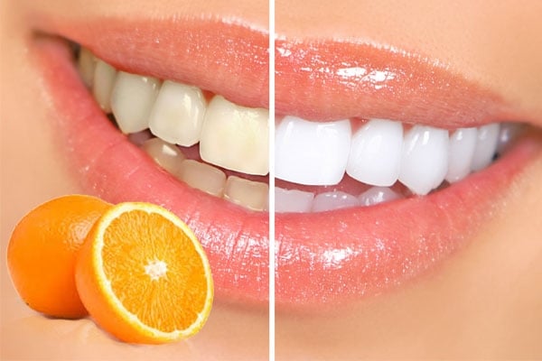 بيّضي أسنانك بـ 60 ثانية فقط واحصلي على ابتسامة النجمات... إليك الوصفة الطبيعية
