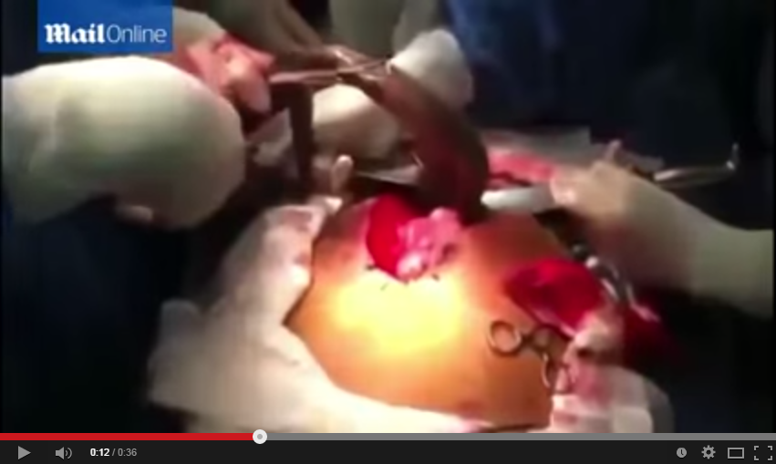 بالفيديو- استخراج سمكة تشبه الثعبان من أمعاء رجل