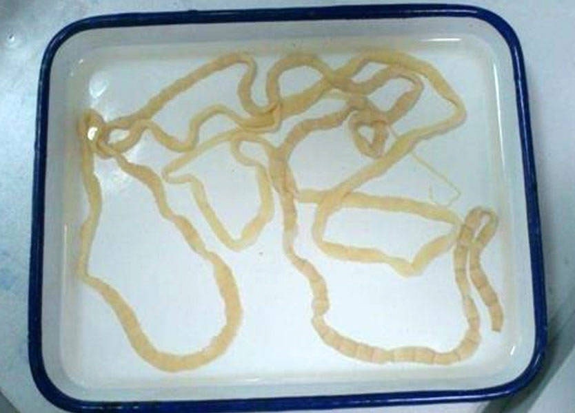 هذه الدودة كانت تعيش في دماغه!