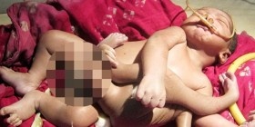 ولادة طفل بثمانية أطراف، والهنود يعتبرونه علامة على قرب نهاية العالم!