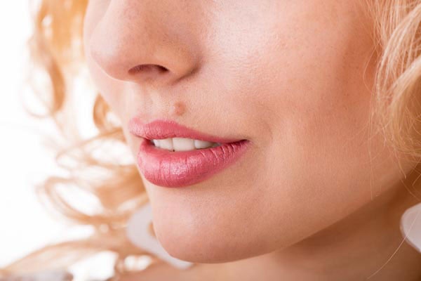 متى تصبح إزالة الشامة ضرورية؟