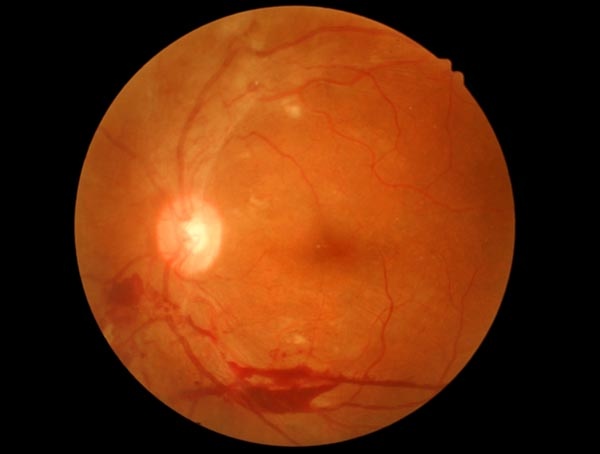 حتى لا يؤدي السكري إلى فقدان البصر