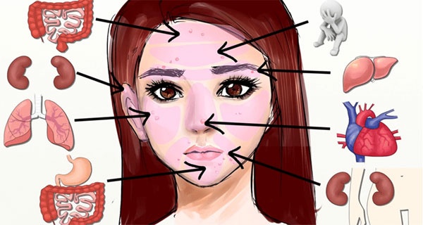 بالفيديو- أنظري إلى وجهك في المرآة، هذا ماذا يخبركِ به حب الشباب عن صحتك!