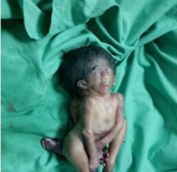 تسريب صورة لطفل مشوّه خلقياً ومتوفي، يشغل غضب السعوديين