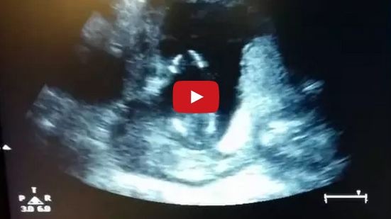 بالفيديو- جنين يصفّق داخل رحم أمه يحصد مليوني مشاهدة!