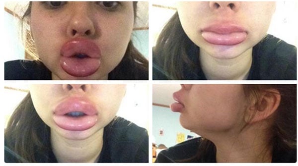 بالفيديو والصور- لعنة آل كارداشيان... تحدي تكبير الشفاه بفوهة زجاجة يشوّه وجوه الفتيات!