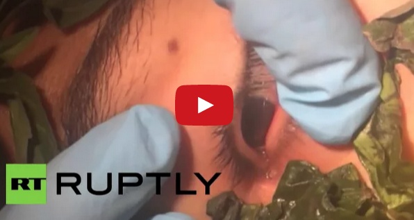 بالفيديو- شاهدوا لحظة استخراج الأطباء دودة بطول 2.5 سم من عين شاب!