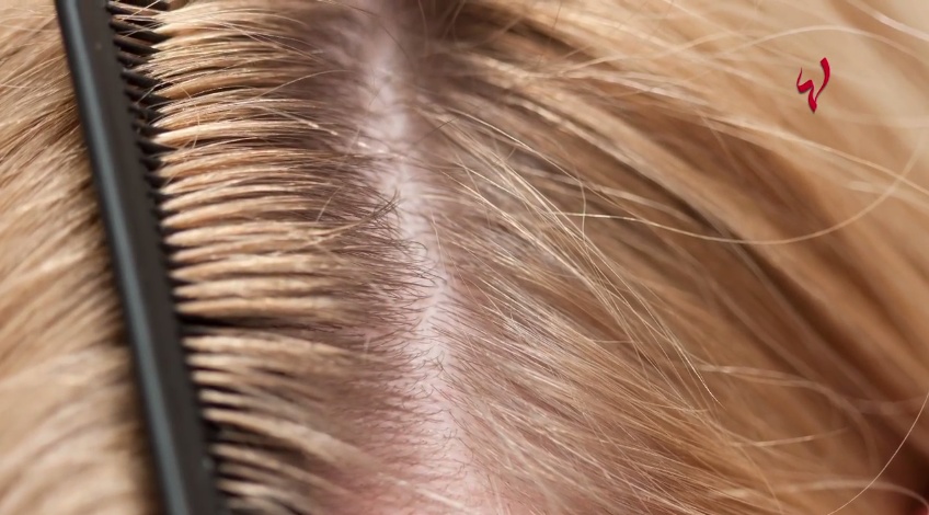 إسألي ماغي - كيف تتخلصين من القشرة؟