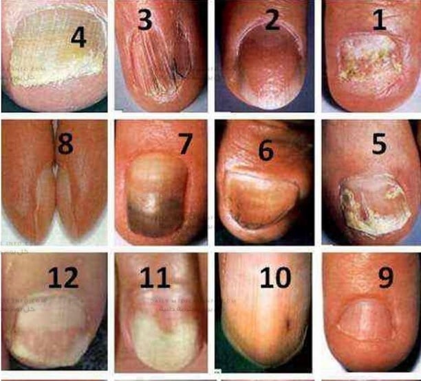 لون أظافرك قد يدل على إصابتك بأمراض خطرة... تعرّف إليها!