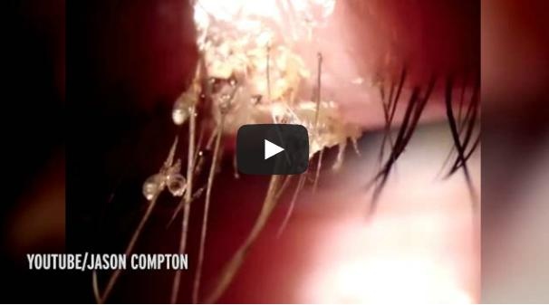 بالفيديو قمل ينمو على رموش امرأة