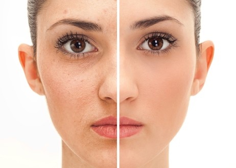 قناع الأسبرين للتخلص نهائياً من البثور وحب الشباب