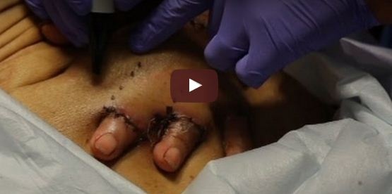 بالفيديو - أطباء يزرعون يد رجل داخل بطنه!