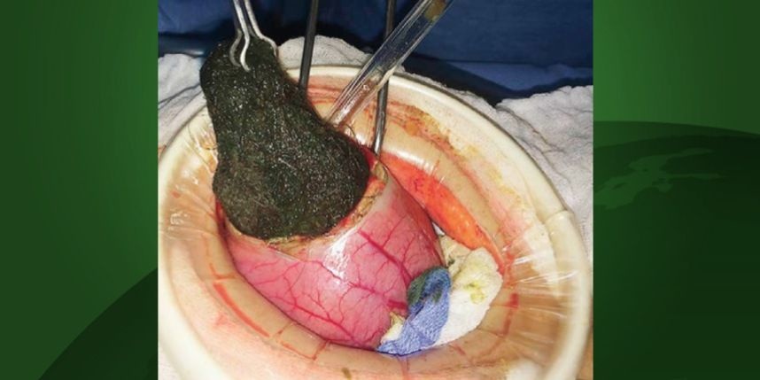 عملية دقيقة لنزع 125 غراماً من الشعر من بطن طفلة !!