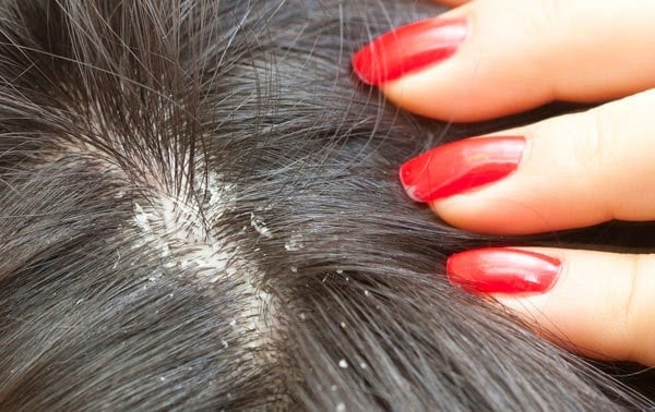 3 طرق فعّالة للتخلص من القشرة بشكل نهائي