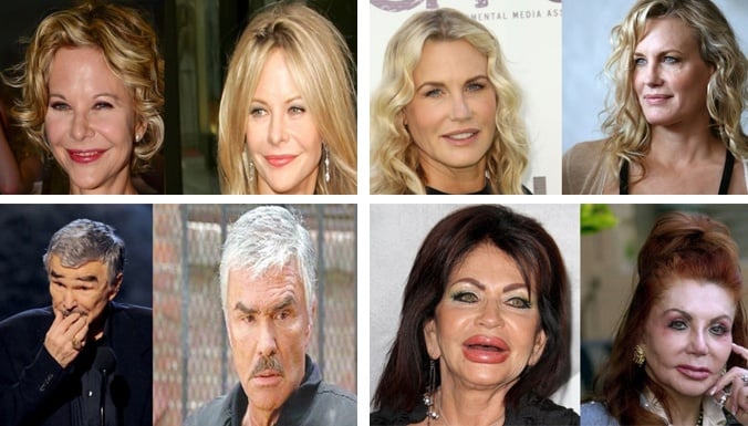 بالصور– 8 مشاهير شوهتهم عمليات التجميل