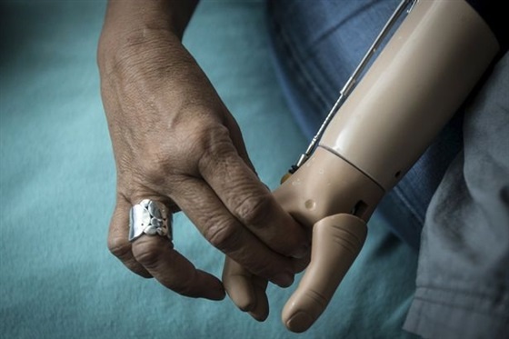 بالصور - طبيب يقطع ذراع طفل لـ