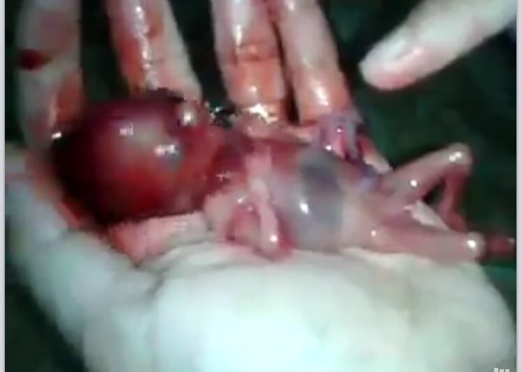 فيديو غير مناسب لذوي القلوب الضعيفة... إجهاض جنين بحجم كف اليد