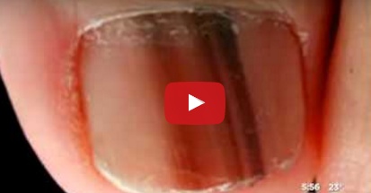 بالفيديو - إحذروا هذا الخطّ الأسود على الأظافر... ماذا يعني؟