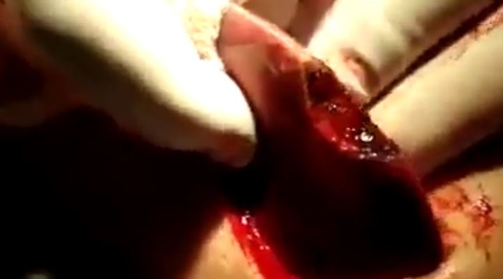 فيديو لأصحاب القلوب القوية.. هذا ما نجده في الكبد بعد تناول كميات كبيرة من اللحوم النيئة