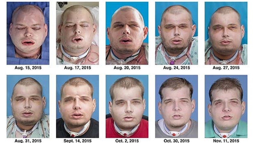 بالفيديو – شاهدوا عملية زرع وجه بالكامل للمرة الاولى.. قبل وبعد!