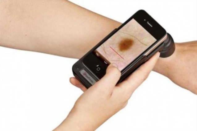 تطبيق ذكي للكشف عن سرطان الجلد!