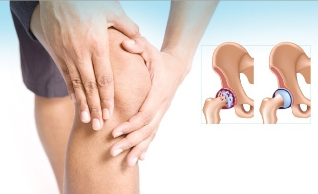 اختبار يتنبأ بالتهاب المفاصل قبل الإصابة بـ 16 عاما