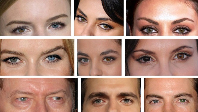 مشاهير لديهم كل عين لون! من هم؟ وما هي هذه الحالة النادرة؟