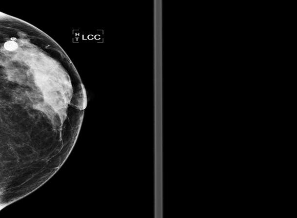 الفحص العيادي للثدي