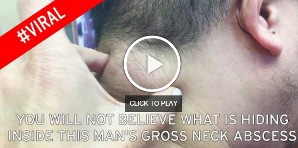 بالفيديو - شاهدوا إخراج ورم من أسفل رأس رجل بحجم كرة الفولف