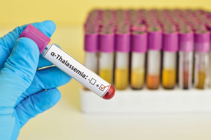 في السعودية: «رعب الاشتباه» بتوريث الثلاسيميا يحطم قلوباً ومشاريع ارتباط