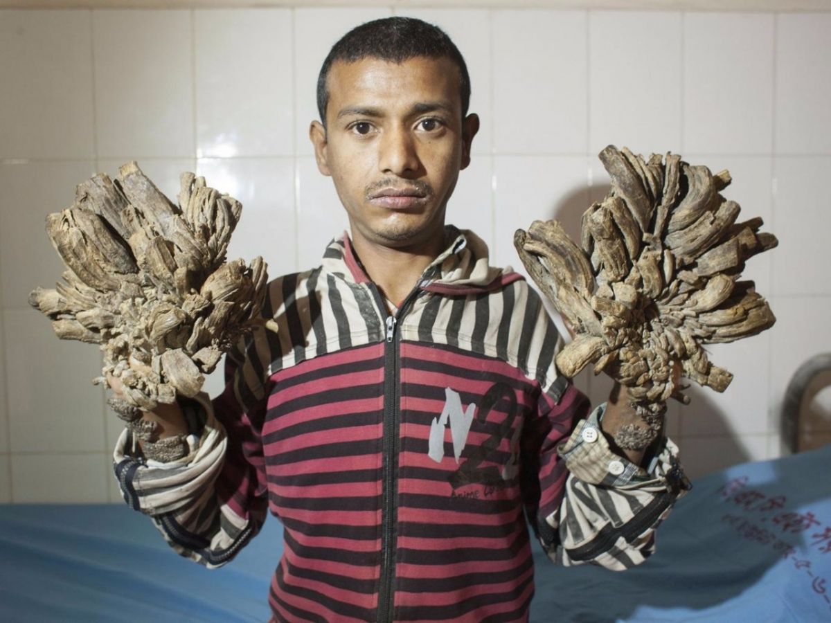 بالصور - مرض غريب يحول جلد هذا الرجل إلى خشب ولحاء شجر