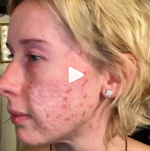 بالفيديو - شاهدوا النتيجة الرائعة بإخفاء بثور الوجه نهائياً.. إليكم الطريقة السهلة