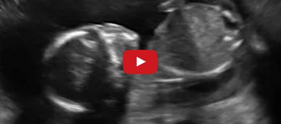فيديو عجيب - جنين يضرب نفسه في رحم امه يصدم العالم