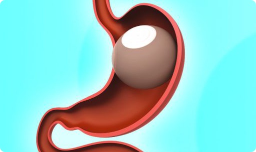 اختبر معلوماتك - بالون المعدة يمكن الاحتفاظ به سنوات؟