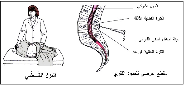البزل القطني يسبّب وجعاً مستمراً في الرأس؟