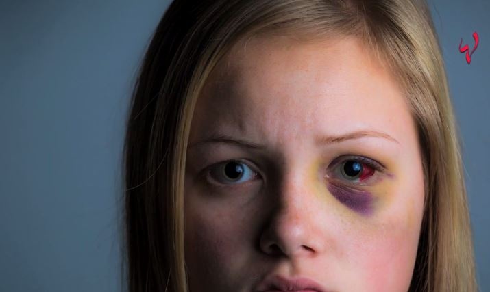 اليك أسباب ازرقاق البشرة وهذه هي الحلول