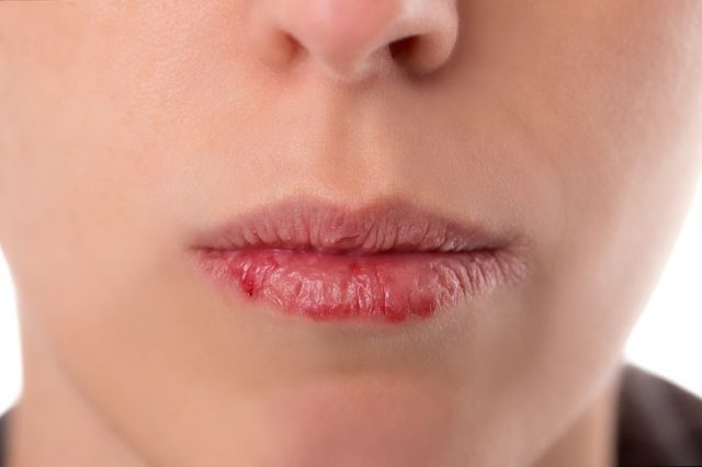 هل تقرح الشفتين دليل على سرطان الفم؟