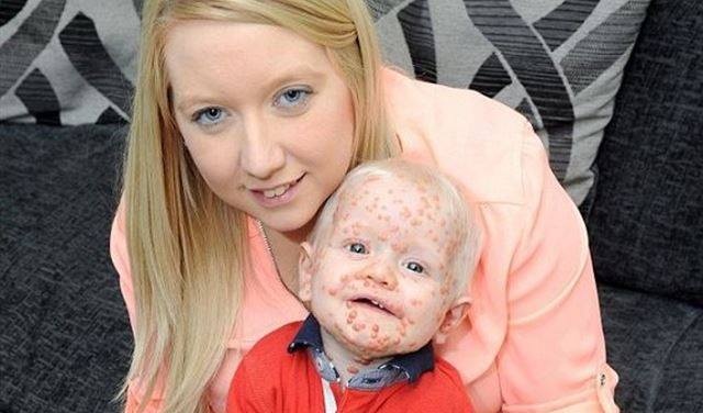 أنجبت طفلاً مصابا بمرض نادر يشبه السرطان بسبب صدمة نفسية... إليكم التفاصيل
