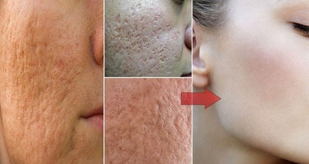 مكونان للتخلص من ندوب حب الشباب.. جربوها